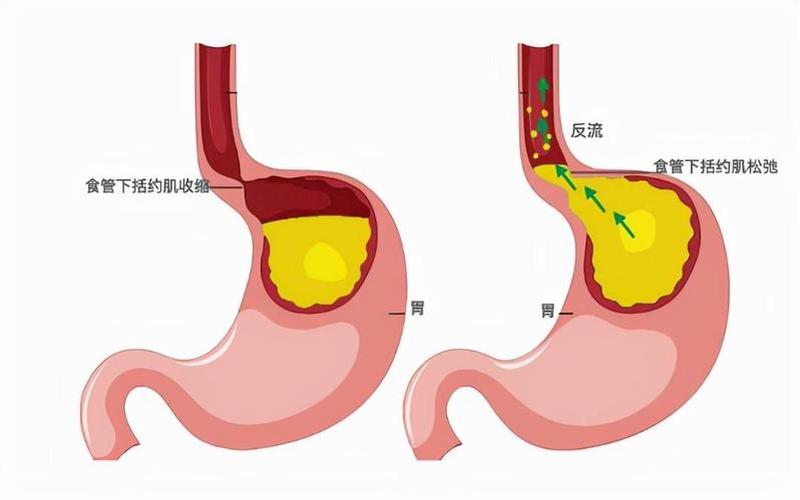 怀孕胃酸是女孩还是男孩(怀孕后胃酸会增多吗)